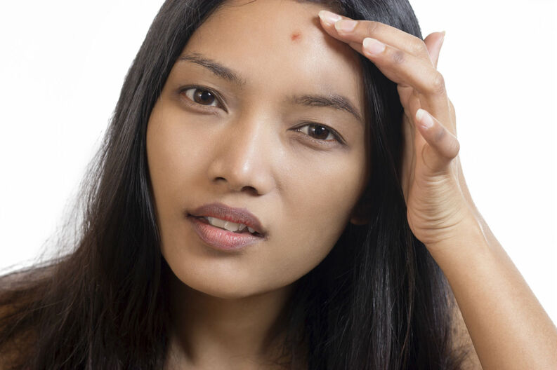 En este momento estás viendo 5 suplementos que eliminan el acné