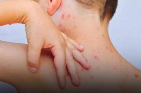 Lee más sobre el artículo Manchas rojas en la piel: principales causas del problema.